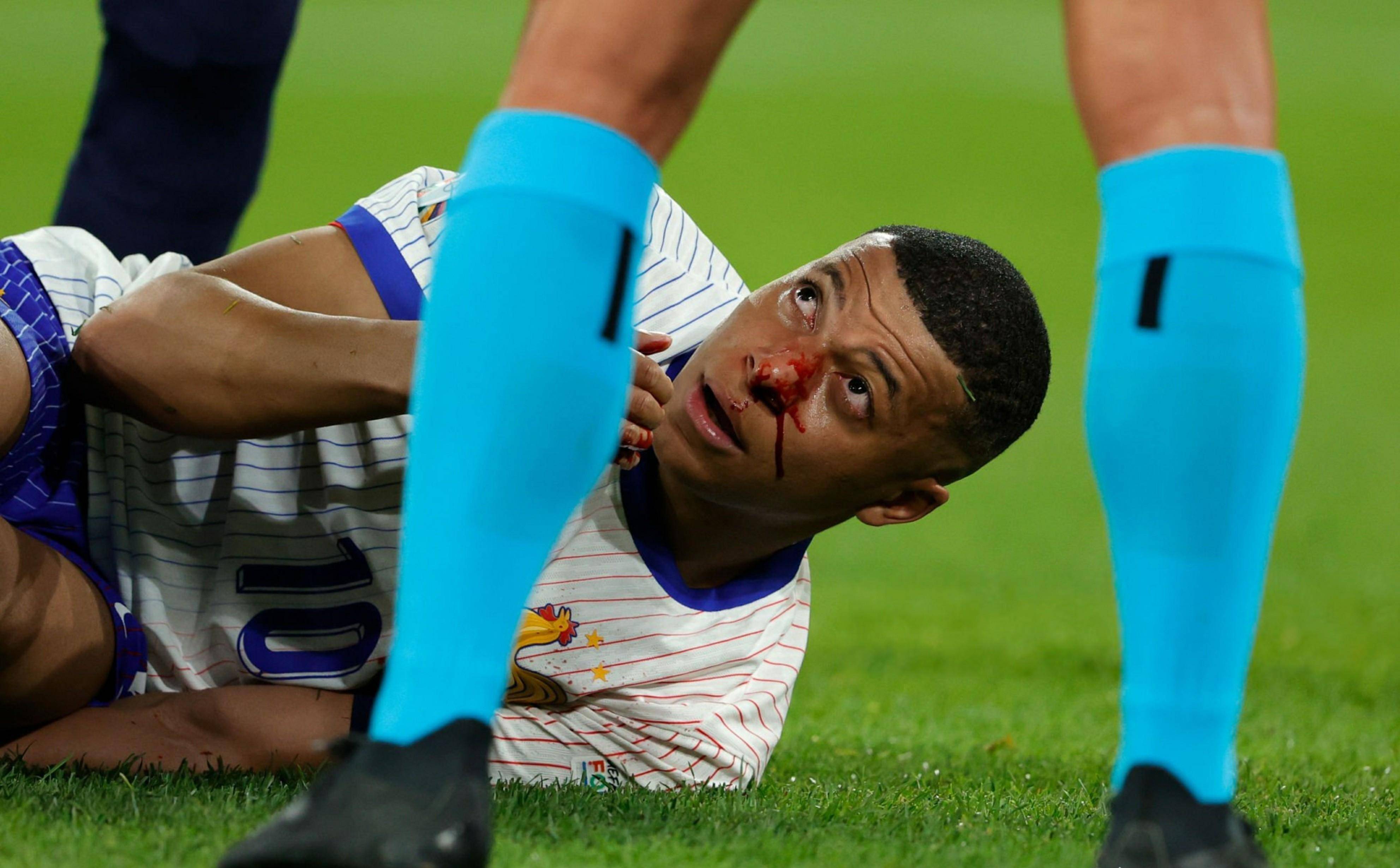 法国队凉了,姆巴佩撞断鼻骨缺席15天比赛,2024欧洲杯或直接报销