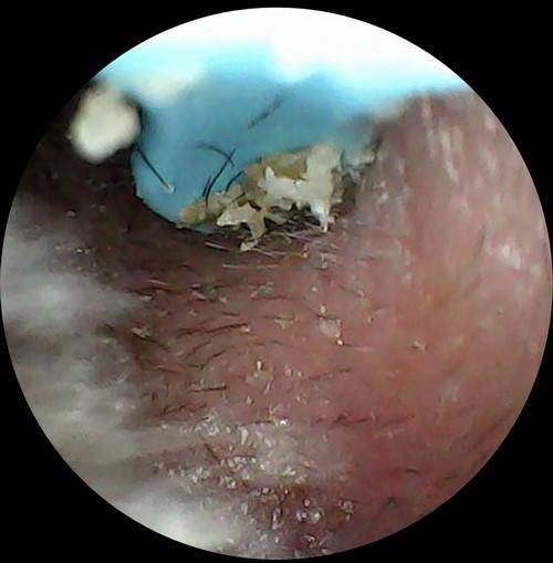 不用去采耳店,西圣Find智能可视挖耳勺让你拥有智能掏耳新体验