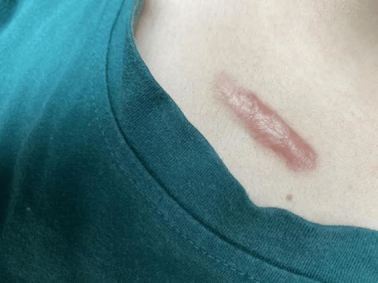 疤痕增生出肉条?学会这三步!缓解刺痛发痒带祛疤一步到位!