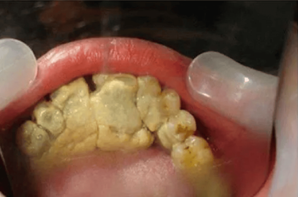 我好像掌握了去牙石的精髓!牙黄口臭的朋友看!用它牙石荡然无存!