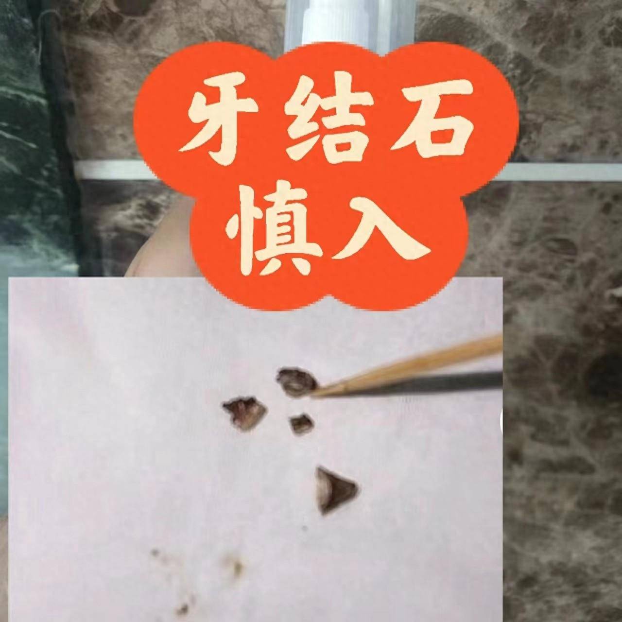 牙结石自己掉了图片