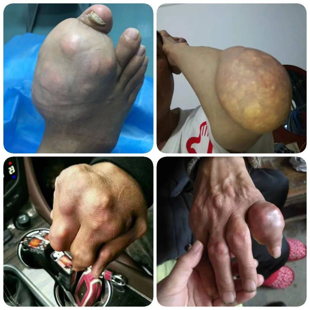 痛风专家张卓解释!