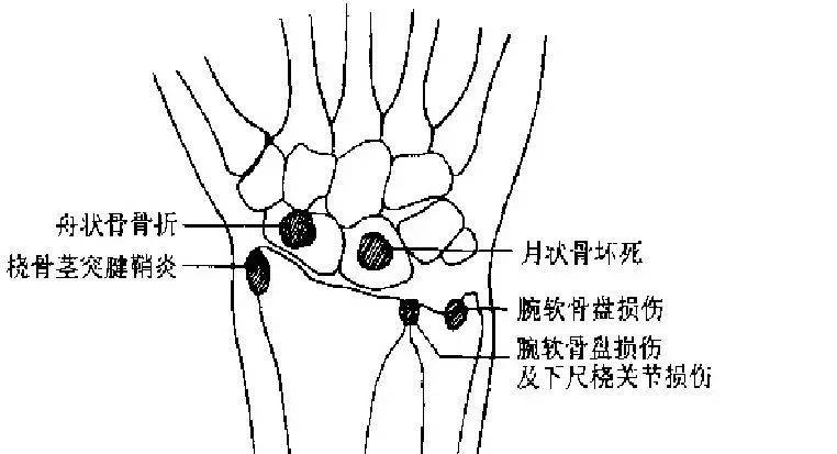 肘直线(4)肘关节外部形状检查(3)冈上肌断裂检查患肢肘关节屈曲9002