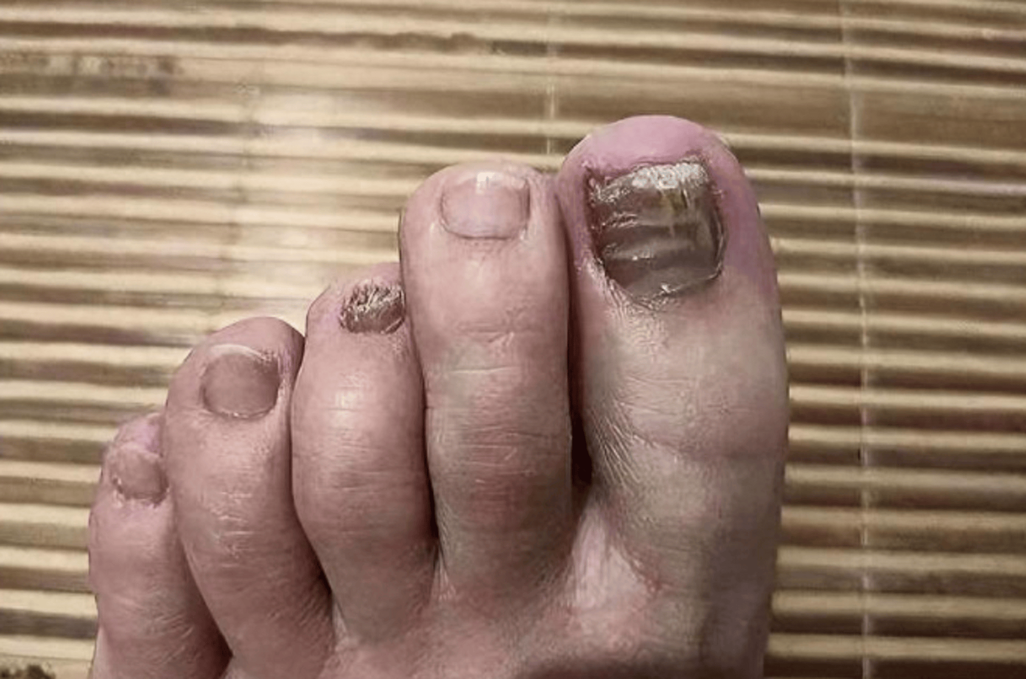 灰趾甲康复者亲测有效的祛灰秘籍大公开!学会立省大几千!