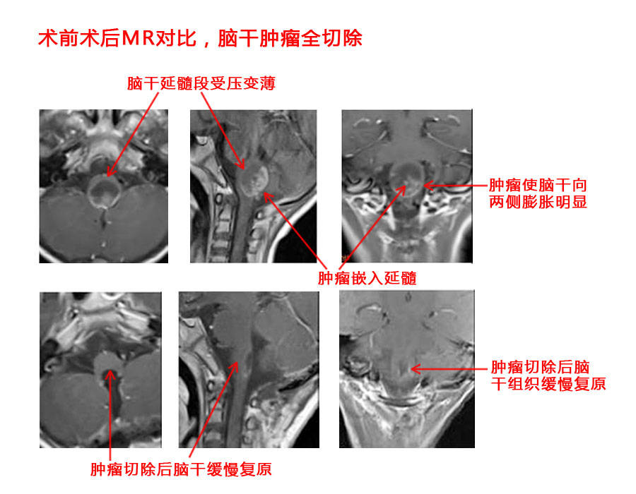 5岁小患者脑干恶性室管膜瘤切除术