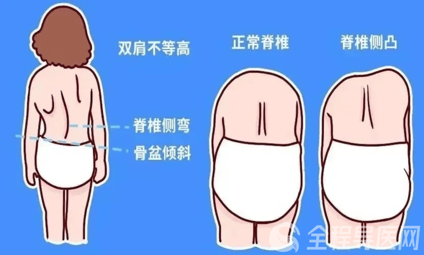 徐矿总医院儿科开展"不良体态及脊柱侧弯矫正"暑期活动