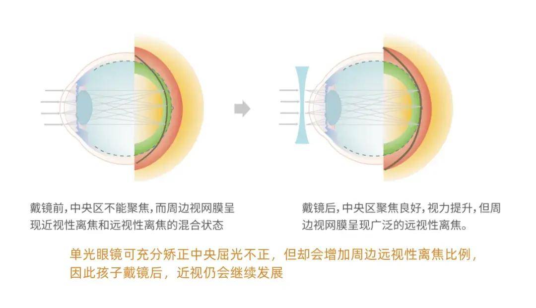 双眼失焦图片