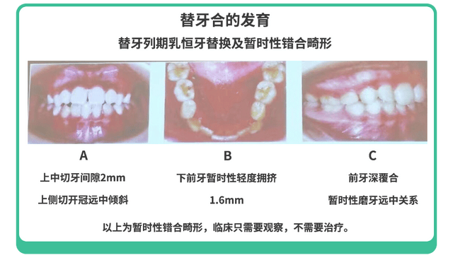 儿童牙齿出现哪些情况需要矫正？乳牙滞留如何处理？