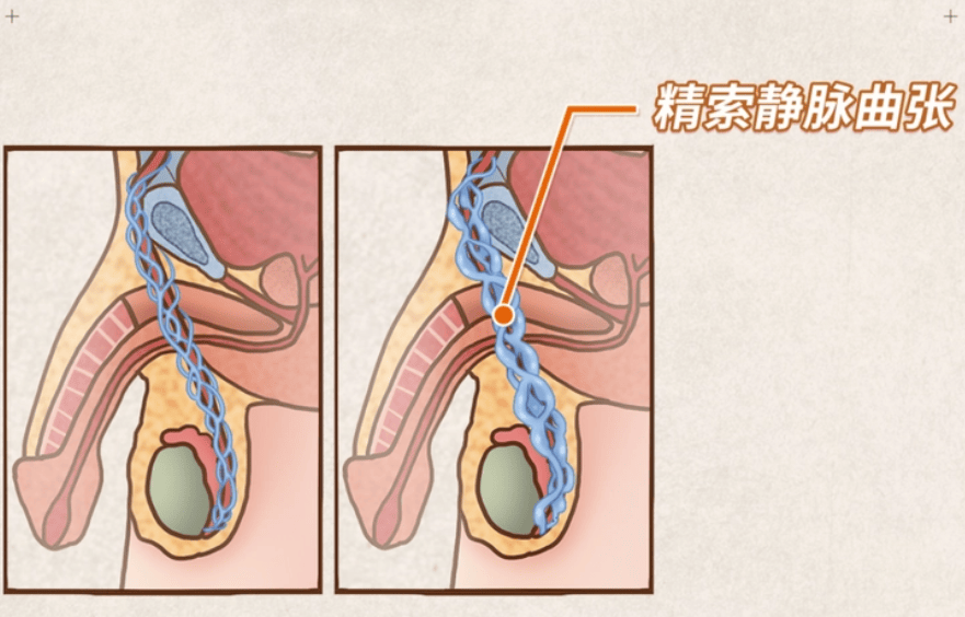 正常的精索静脉图片