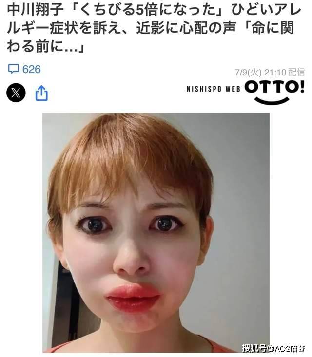 心疼又好笑！ 二次元宅男女神意外患病 嘴唇肿成香肠状 网友