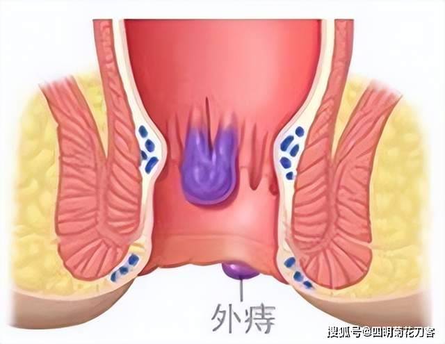 肛门周围长痔疮图片图片