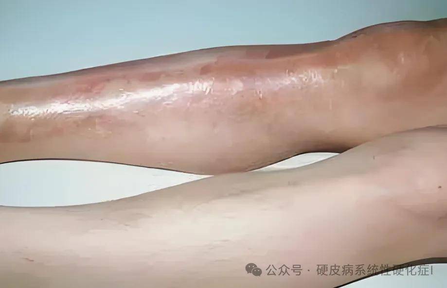 硬皮病:难道"变硬"的只有皮肤吗?_患者_影响_症状