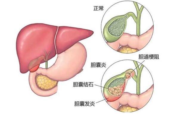 在我国的发病率仅次于阑尾炎