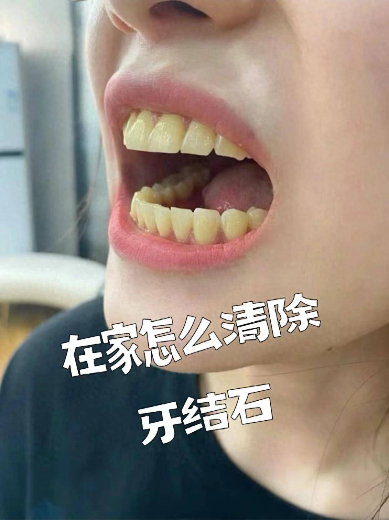堆积如山的牙结石,学会这个方法两个月全掉光!_牙粉_牙齿_牙缝里