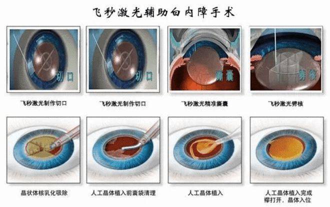 眼睛美白术图片