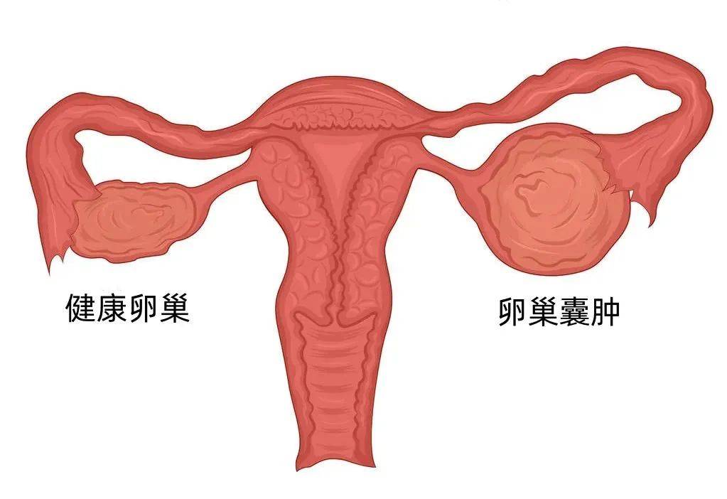 巧克力囊肿到底是啥丨西安邱学华医院丨西安妇科医院推荐