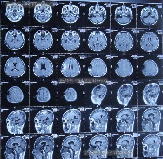 后堵管感染,河北转广州高端医院但治4个月仍意识不清_头颅_脑室_给予