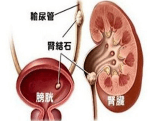 武汉肾结石医院