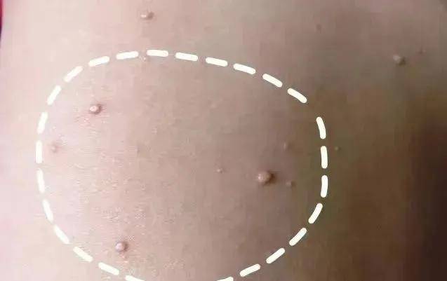 私处长了"痘痘",难道是得"那病"丨西安邱学华医院_治疗_外阴_皮肤