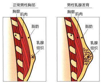 男性乳腺腺体发育图片