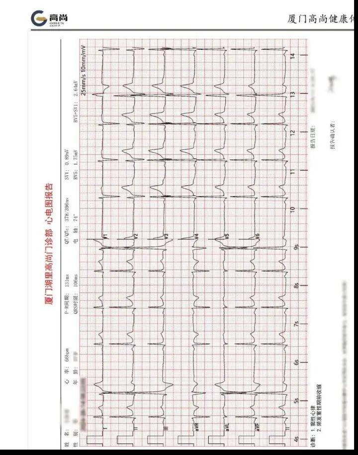 24小时心电图指标解读图片