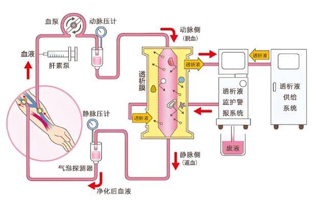 便携式人工肾图片