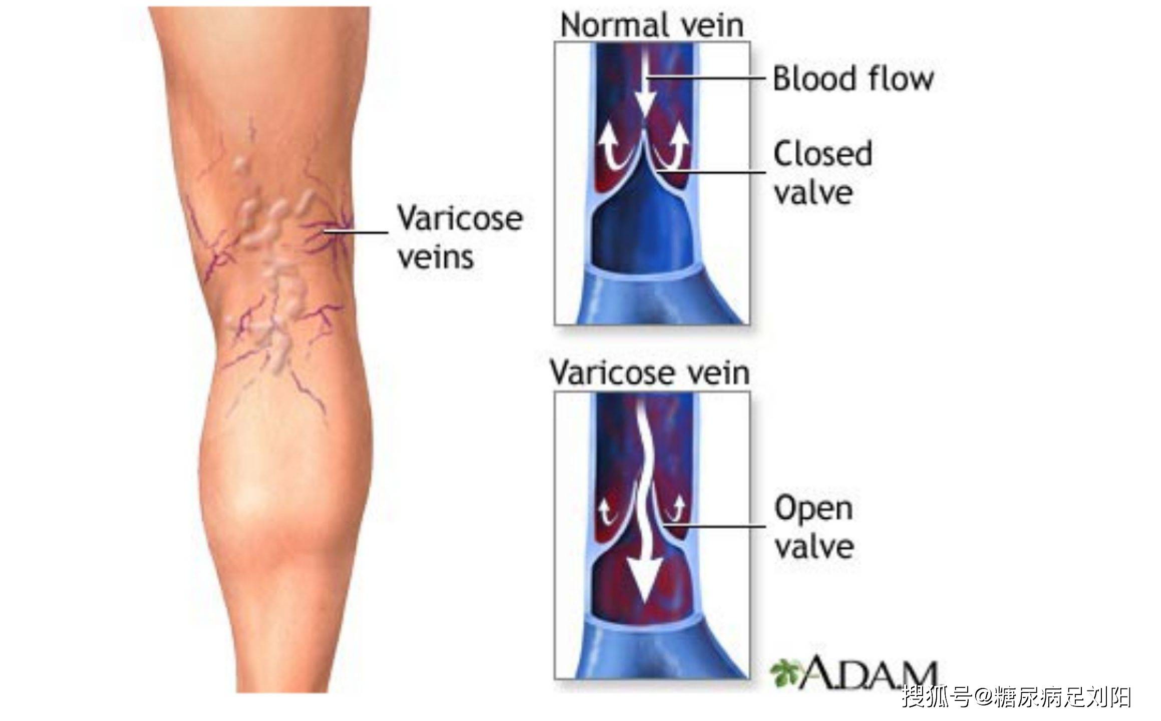 下肢静脉瓣图片