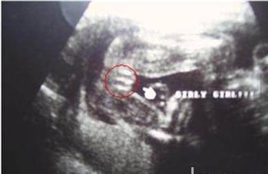 男孩女孩b超有哪些区别 教你轻松看出胎儿性别