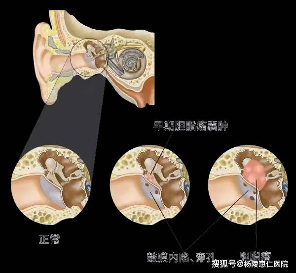 耳朵肉芽切除手术图解图片