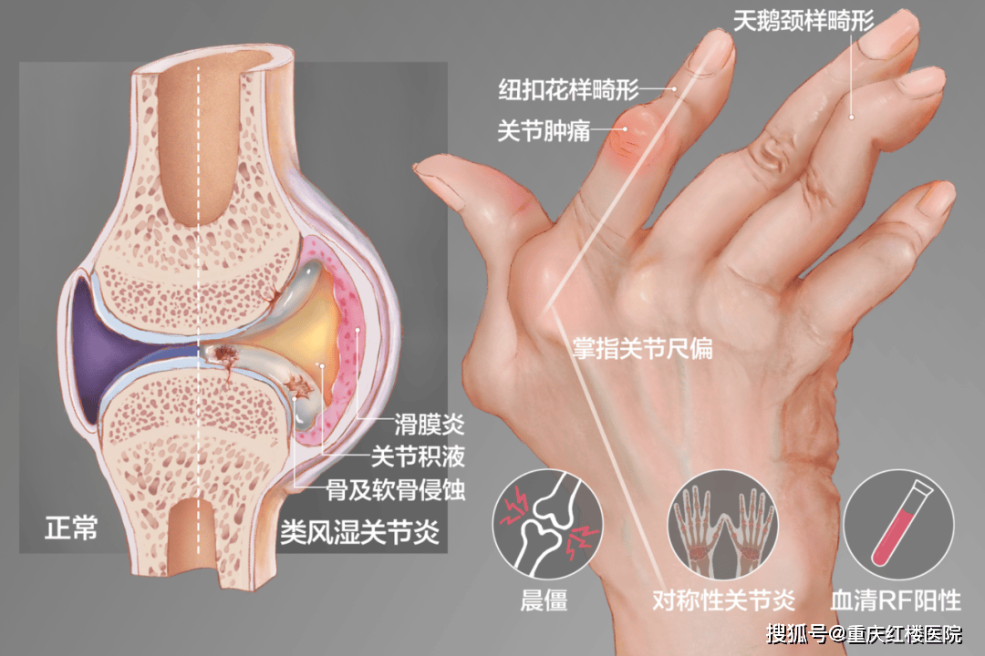 类风湿小结图片图片