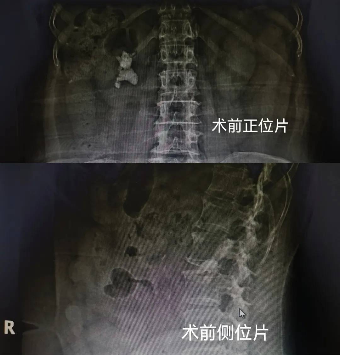 B超肾结石图片