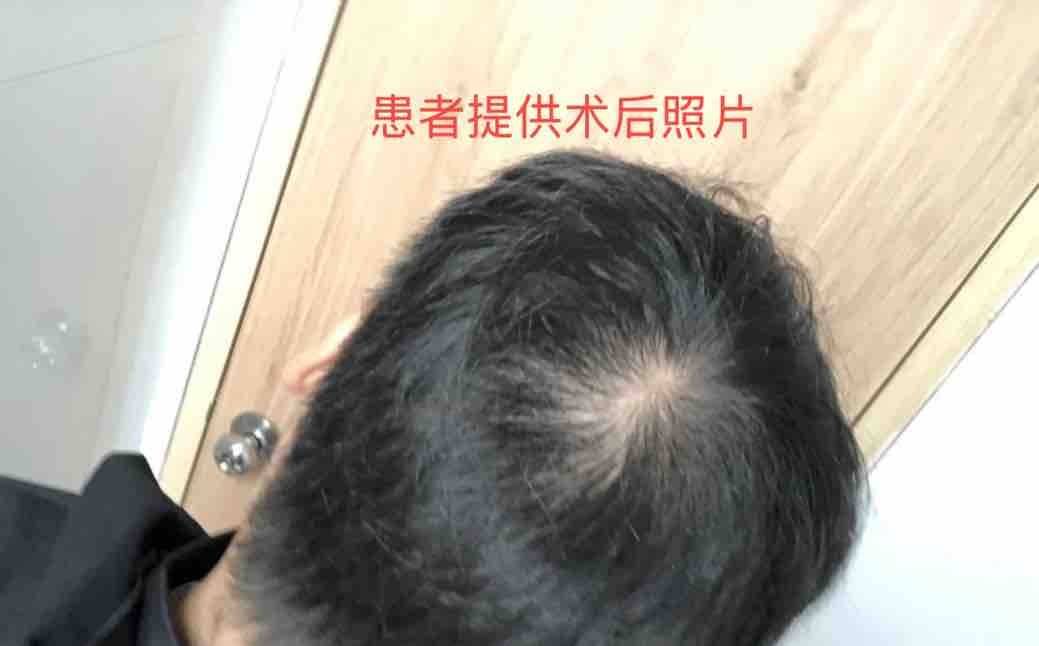 植发后不如不植?新京报曝雍禾医疗存活率五大保障履约难(图9)