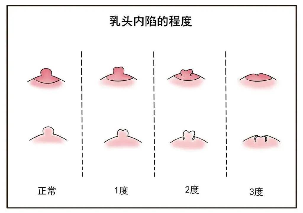 正常乳头女性 大小图片