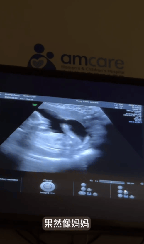 原创张檬去香港产检b超显示怀男宝脱鞋测重竟现严重拇外翻
