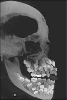 邢台种植牙专家:菲律宾男孩长了300余颗牙齿,是世界首例极端"多齿症"