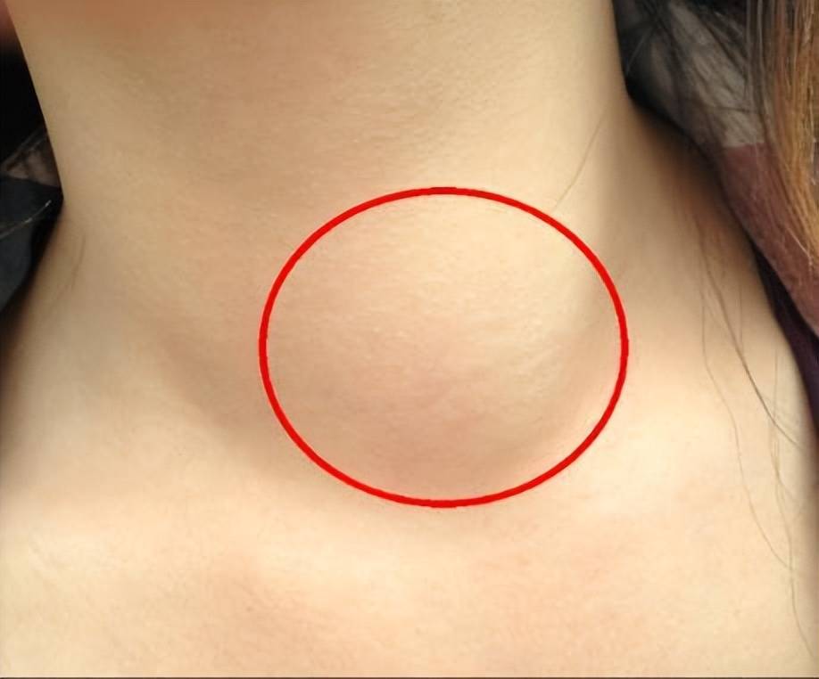 乏力?脖子肿大?可能甲状腺炎作怪!9类人群做好预防