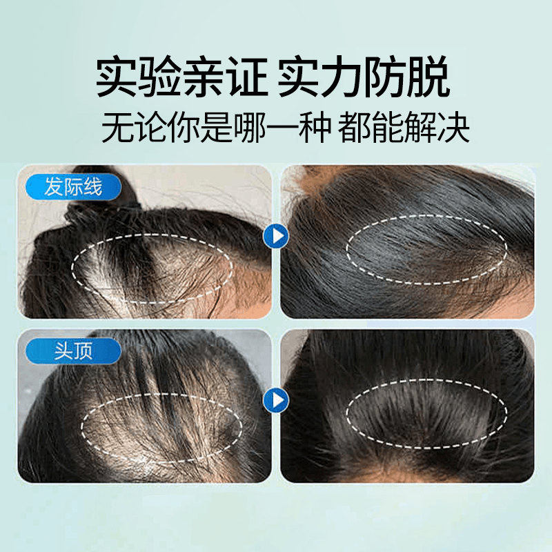 脱发严重,防脱发生发增发密发哪个牌子好?秃发认准这些_头皮_脱育发_脱期