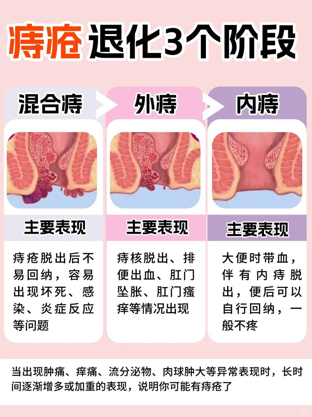 痔疮治疗最佳方法!