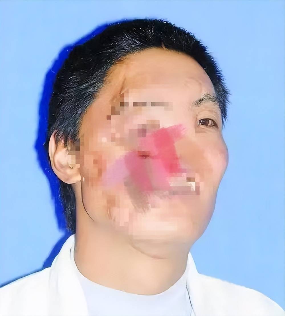 中国换脸第一人李国兴:被熊袭击面部,换脸手术成功半年离奇死亡