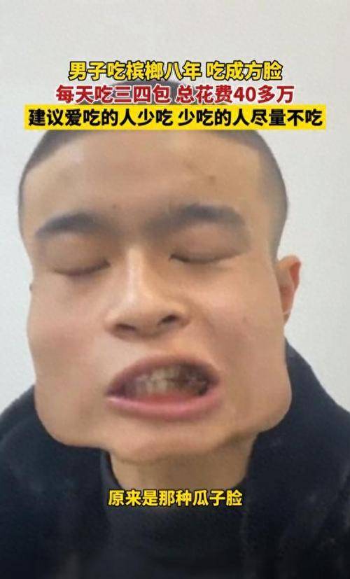 18岁小伙嚼槟榔8年脸方成电视机:单单买槟榔就花了40多万