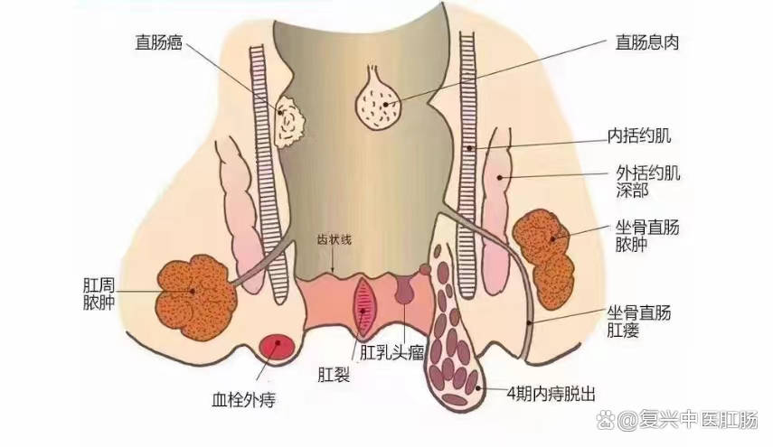 肛裂赘生物图片图片