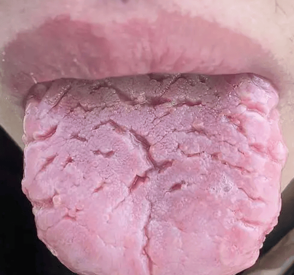 注意裂纹舌可能暗示这些健康问题快自查