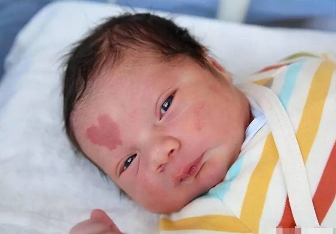 胎记是怎么来的?产科医生:孕期尽量避开3种行为,以免害了胎儿_宝宝_不会影响_孩子