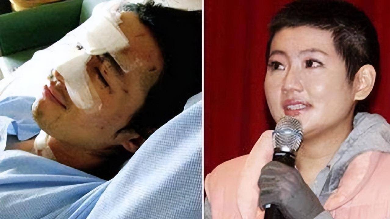 而任家萱下半身也严重烧伤,幸运的是脸完好无损,只要好好治疗定会恢复