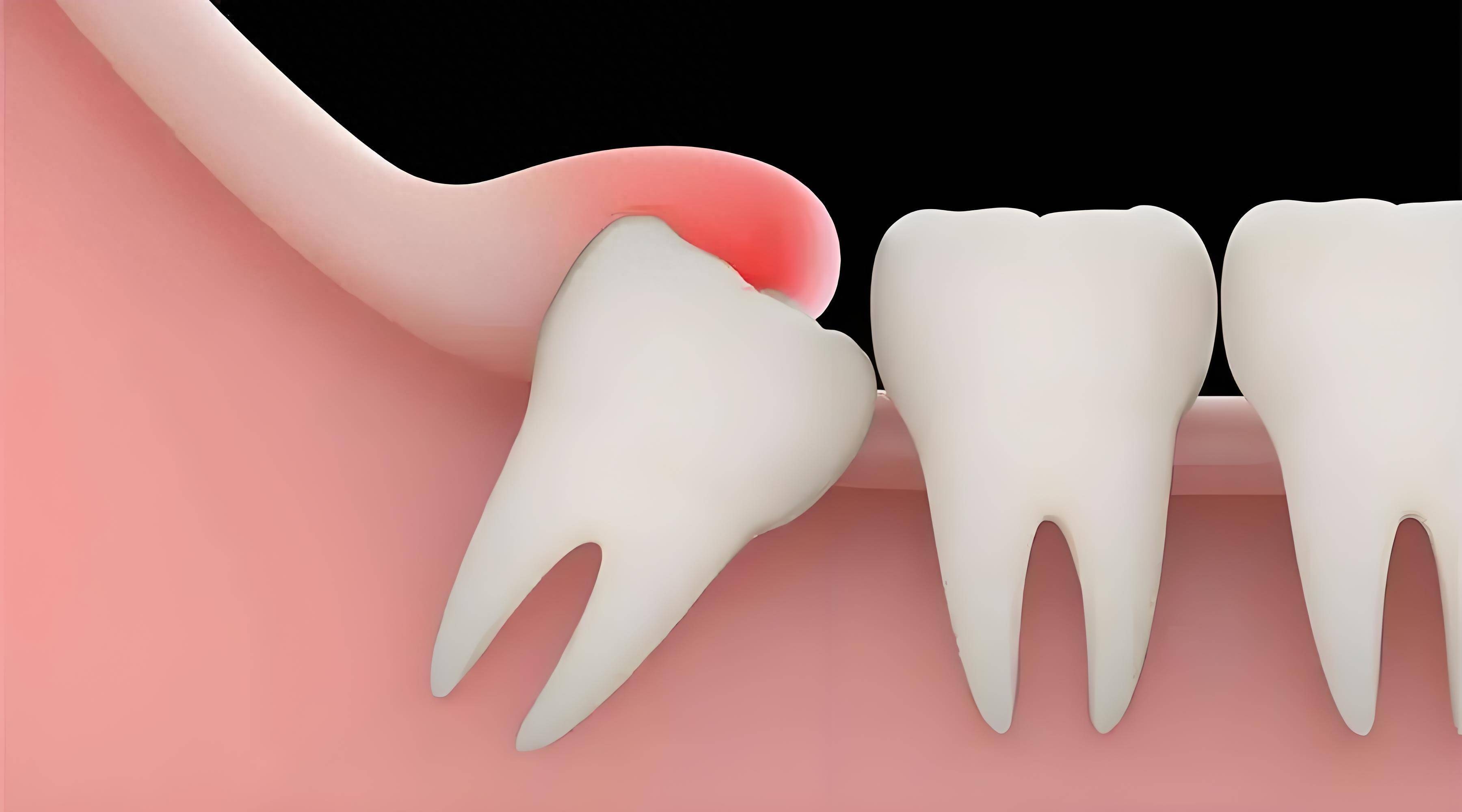 智齿出现症状,别不当回事,小心并发症发生,及时拔掉