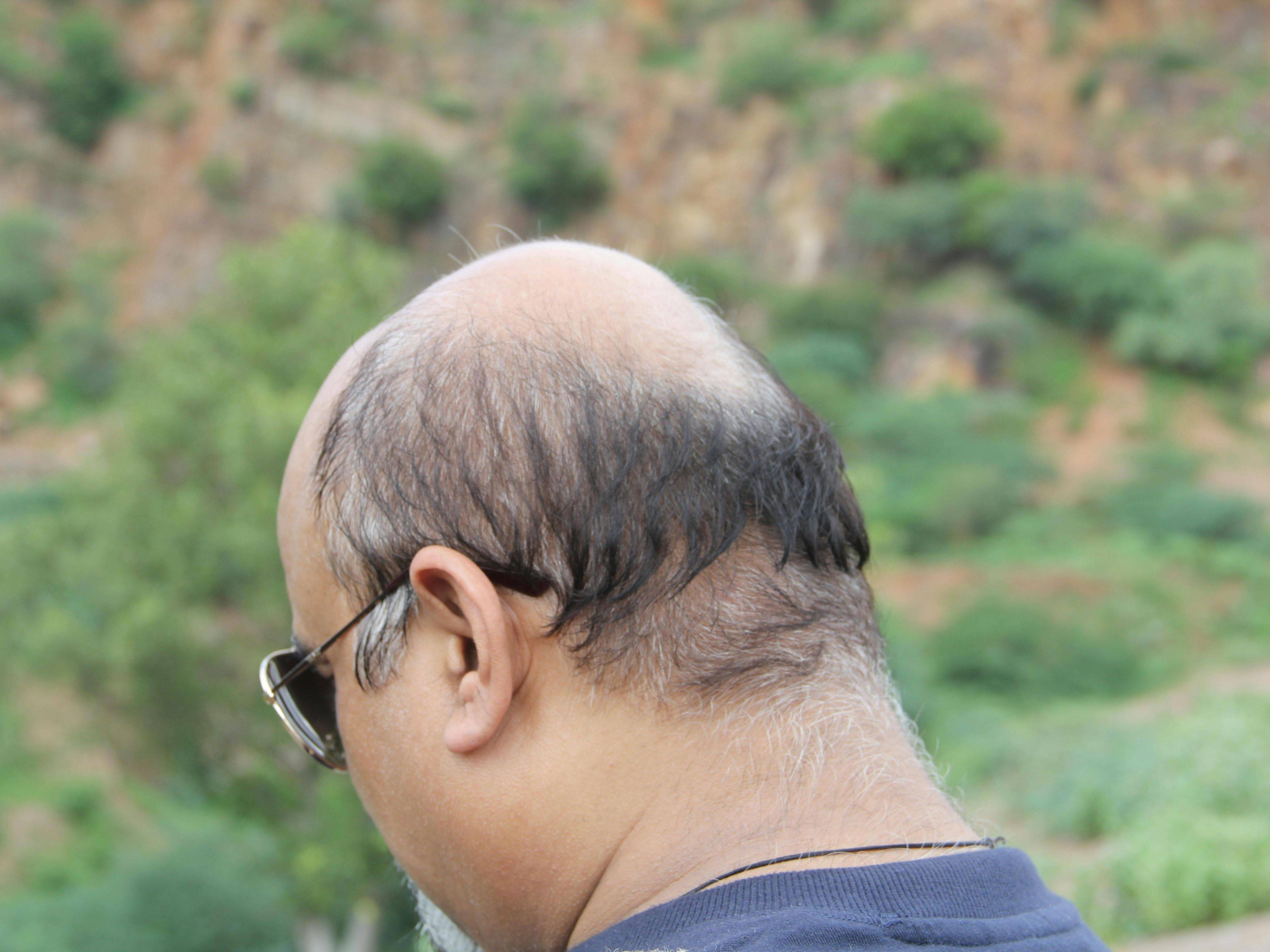 崇文中方出手,秃头问题迎刃而解!