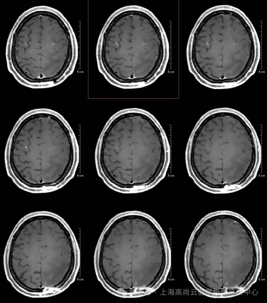 多参数mr综合评估肺癌脑转移
