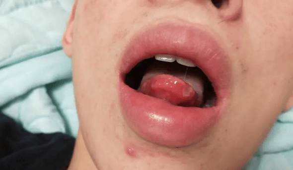 从口腔溃疡到全身病变:白塞氏病敲响的健康警钟