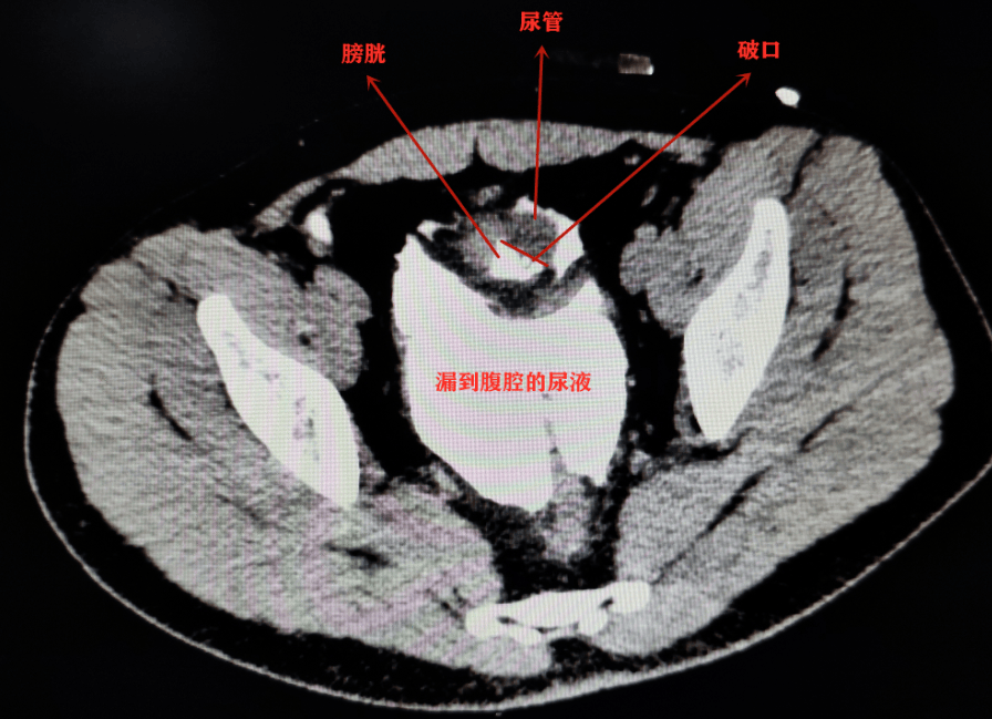 "ct膀胱造影检查结果让所有人倒吸冷气:膀胱真的破了,腹腔里全是尿液!