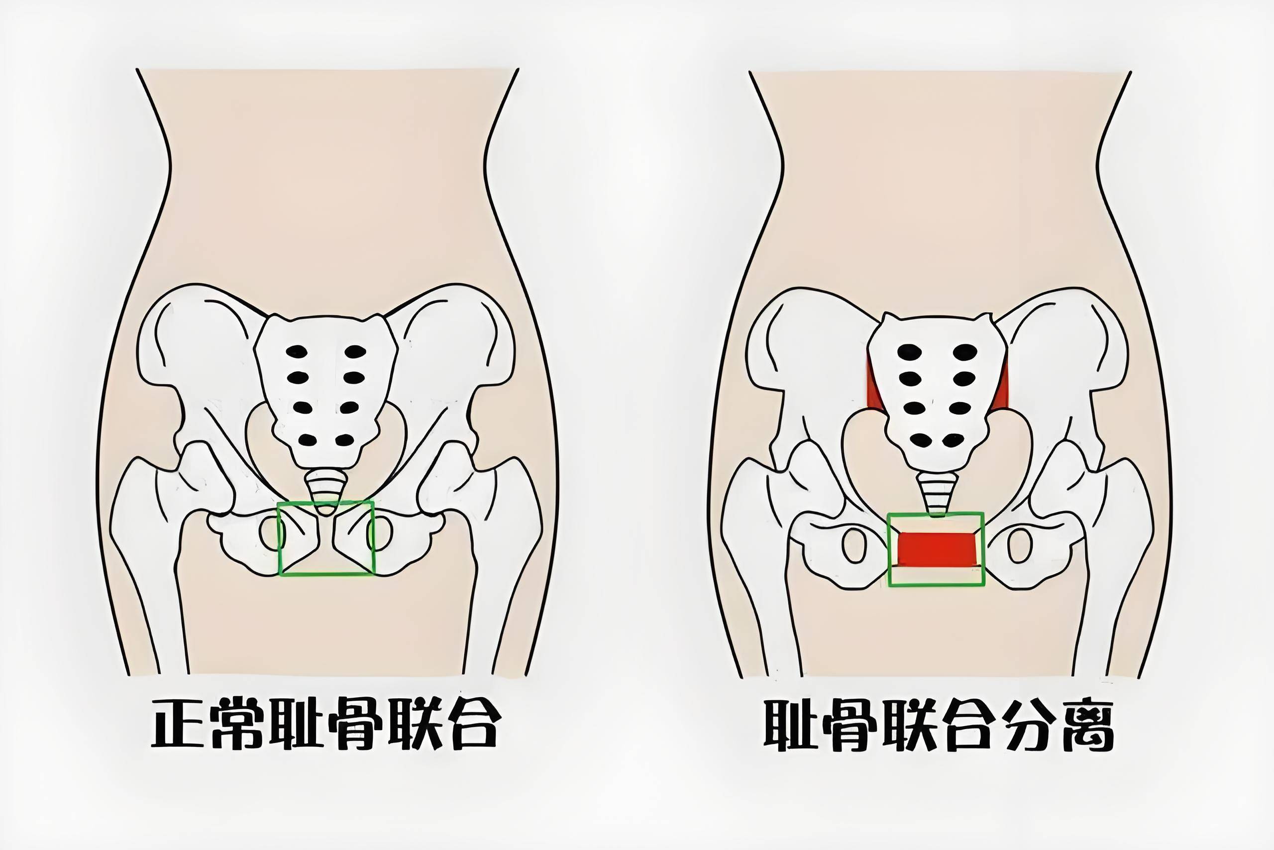 这些方法让你产后"胯"越重生!